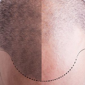زراعة الشعر في تركيا